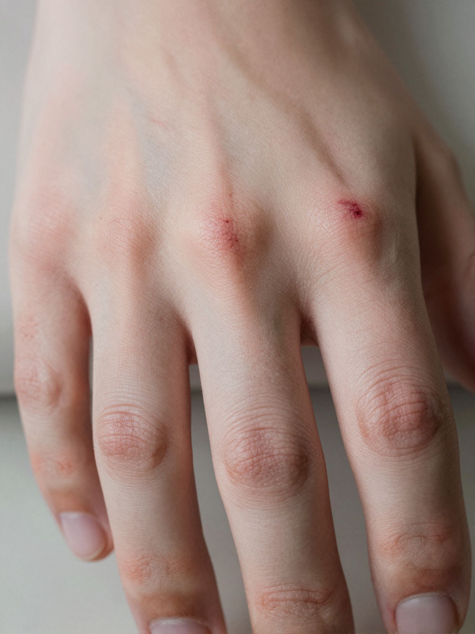 Az ujj megkarcolásáról álmodni belső sérüléseket és el nem mondott fájdalmak titkos üzenetét rejti.